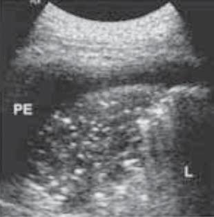 Os sinais de efusão pleural à abordagem abdominal incluem líquido anecóico abaixo do diafragma, visualização do interior do tórax através do acúmulo de líquido, ausência de reflexão
