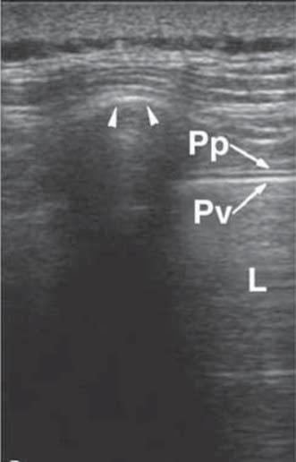 Quando a doença pleural assumir uma posição intermediária, entre fase exsudativa e crônica organizada, a loculação, a septação e a adesão podem ser desfeitas pela videotoracoscopia (12,13).