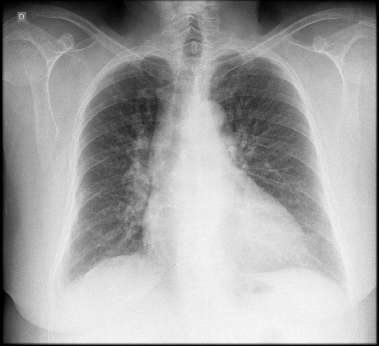 Figura 1 Radiografia de tórax PA: aumento da trama vascular pulmonar e área cardíaca ligeiramente aumentada com retificação do arco médio.
