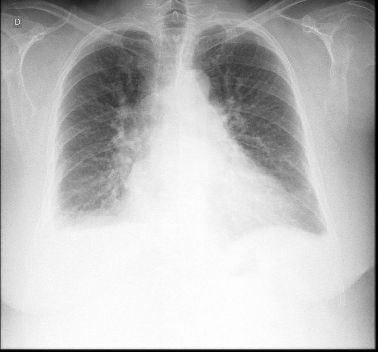 Pitta e cols. Figura 2 Radiografia de tórax PA: velamento dos seios costofrênicos bilateralmente, aumento da trama vascular pulmonar e aumento da área cardíaca.