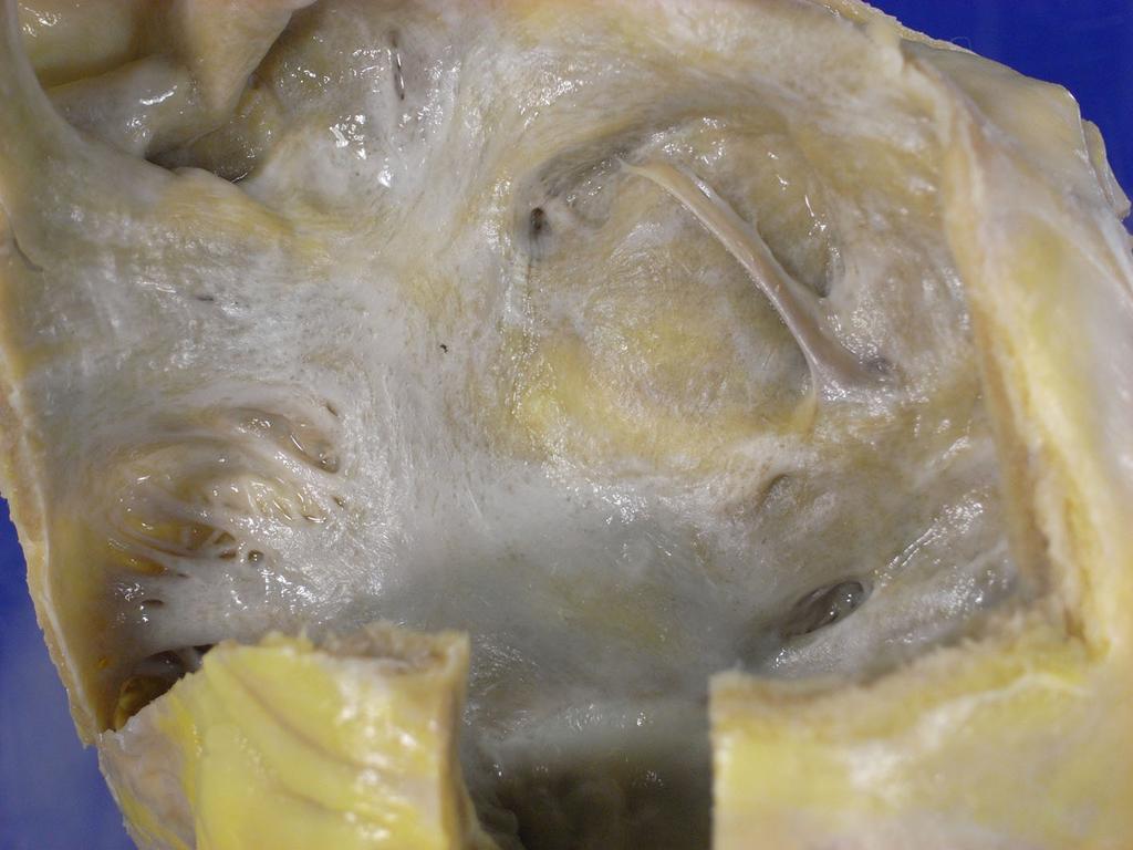 Figura 6 Lado esquerdo do septo atrial. As áreas irregularmente amareladas correspondem a depósito amilóide.