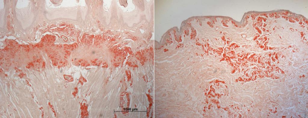 Figura 8 Cortes histológicos mostrando depósitos amilóides fora do sistema cardiovascular língua (painel esquerdo) e pele (painel direito).