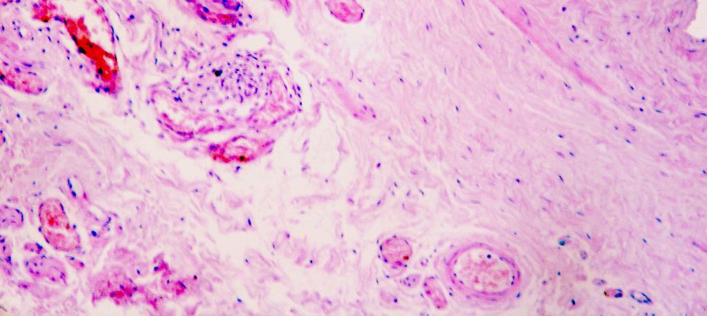 Observar revestimento mesotelial (RM), feixe de musculatura lisa (ML)