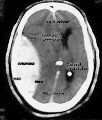 CLASSIFICAÇÃO DO TCE Lesões intracranianas focais: Hematoma