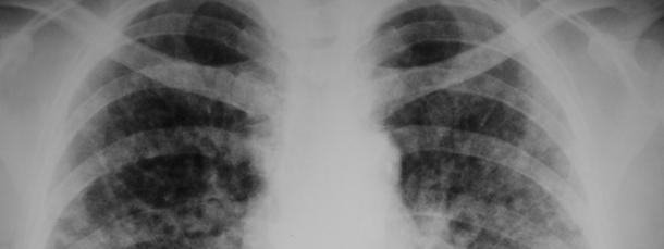 Por fim, algumas neoplasias malignas, como o linfoma e o carcinoma bronquioloalveolar, também podem se apresentar na forma de múltiplos nódulos pulmonares (figura 9). Figura 9.