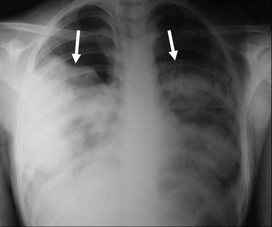 Figura 5. Metástases pulmonares de osteossarcoma.