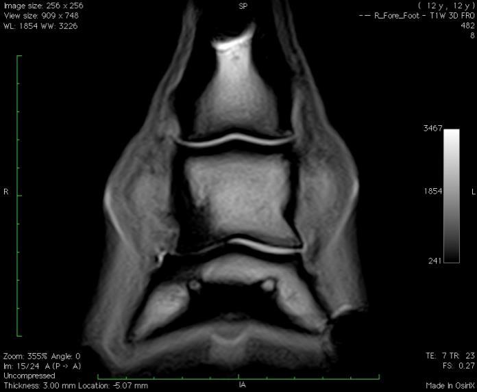 pela Clinica Equina San Biagio). Figura 5 Imagem frontal de RM de sequência T1-W, da região do dígito do MAD.