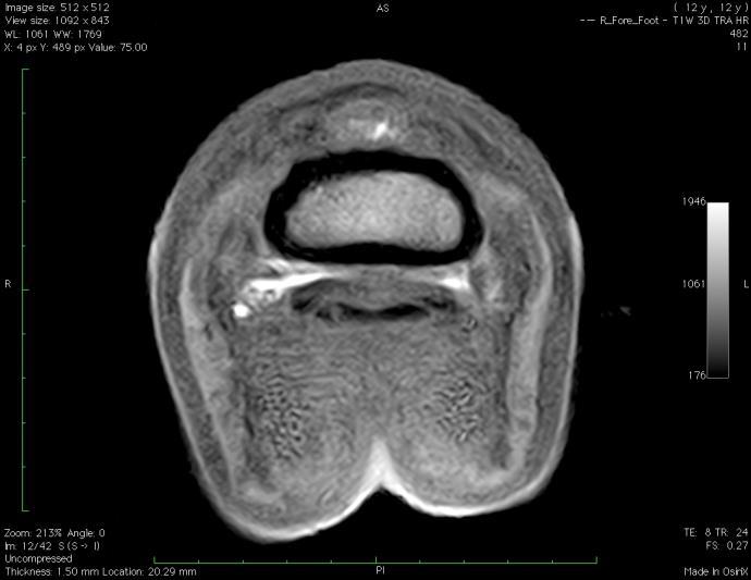 É visível uma extensa alteração de sinal na cartilagem articular lateral da AID, caracterizada por uma redução difusa de sinal com