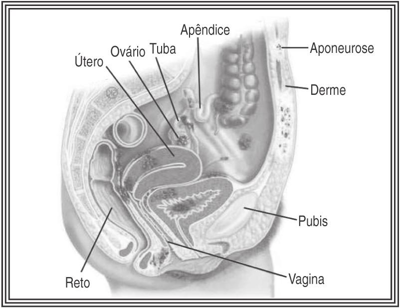 Ser ou não ser fértil IN? 2) Em quais lugares do organismo surge a Endometriose?
