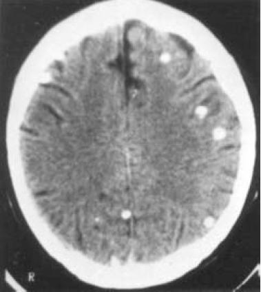 Entretanto, EEG pode identificar uma área epileptogênica e assim colaborar para que se estabeleça ou não uma correlação entre a lesão