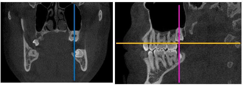 44 A angulação do terceiro molar superior no eixo vestíbulo-palatal foi avaliada no corte coronal (Figura 1A), definido pelo posicionamento do plano de referência do corte transversal na junção