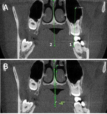 45 Figura 2. Linha 1 passando pelo longo eixo do terceiro molar superior e linha 2 passando pelo plano sagital mediano. B Intersecção das linhas 1 e 2 e formação do ângulo vestíbulo-palatal. Figura 3.