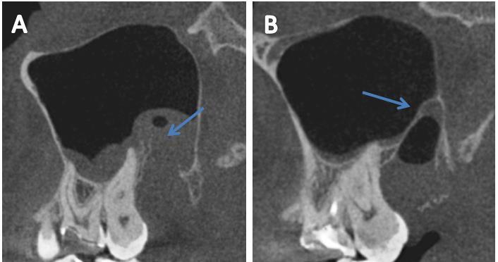 67 Figura 5. Imagem de rompimento da cortical óssea do seio maxilar (A) e imagem de cortical óssea do seio maxilar íntegra (B).