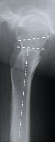 começando 10mm acima da junção do grande trocanter com o colo femoral, e é idealmente realizado em um ângulo de 50* em relação ao eixo femoral.