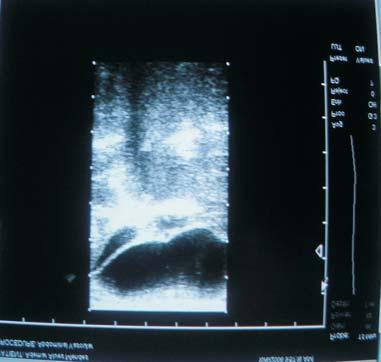 Figura 1 Ultra-sonografia evidenciando uma linha não ecogênica contígua à bexiga (seta), sugerindo ureter ectópico dilatado.