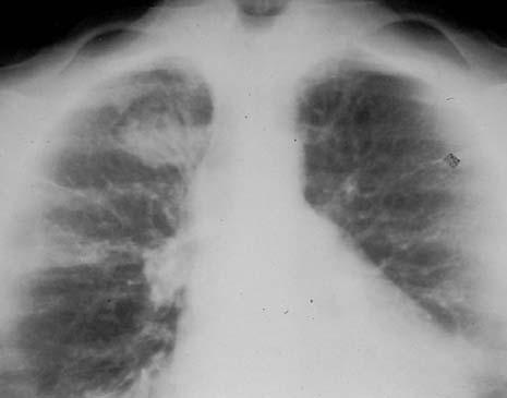 Esta incidência tem grande valor para a avaliação dos ápices pulmonares, lobo médio e língula (figura 6). A B Figura 6.