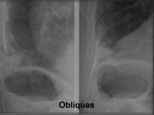 A radiografia simples em PA (A) demonstra nódulo na base esquerda, parcialmente sobreposto ao coração.