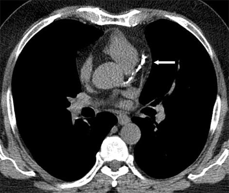 Arq Bras Cardiol Os dados foram separados em 7 faixas etárias: < 40 anos, 40-44 anos, 45-49 anos, 50-54 anos, 55-59 anos, 60-64 anos e > 65 anos.