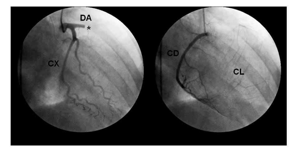 Fig. 2 - Coronariografia demonstrando a oclusão trombótica proximal da artéria descendente anterior e presença de circulação colateral inter e intracoronária.