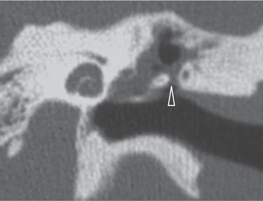média (7). tomografia computadorizada multislice (TCMS) é considerada técnica de imagem de escolha para a avaliação do colesteatoma da orelha média.