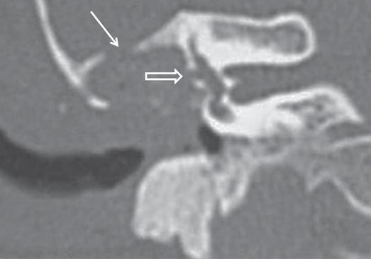 C Figura 6. : TCMS com reconstrução multiplanar em coronal: tecido mole inespecífico no interior da orelha média.