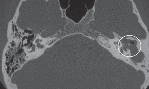 Lesão colesteatomatosa em orelha média associada a osteólise da cadeia ossicular à esquerda (círculo).
