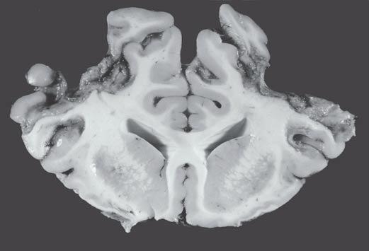 A superfície de corte evidencia áreas de desaparecimento do córtex telencefálico e áreas gelatinosas
