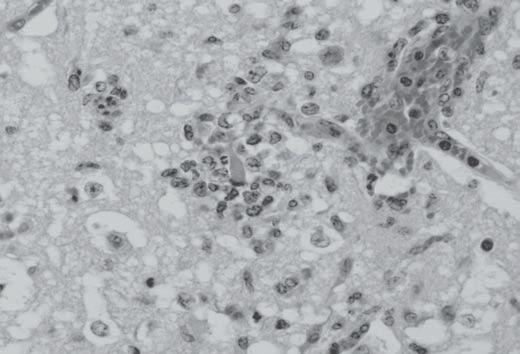 Malacia, caracterizada por necrose do componente neuroectodérmico com manutenção do componente vascular e acentuada infiltração por macrófagos com citoplasma espumoso (células Gitter), no encéfalo de