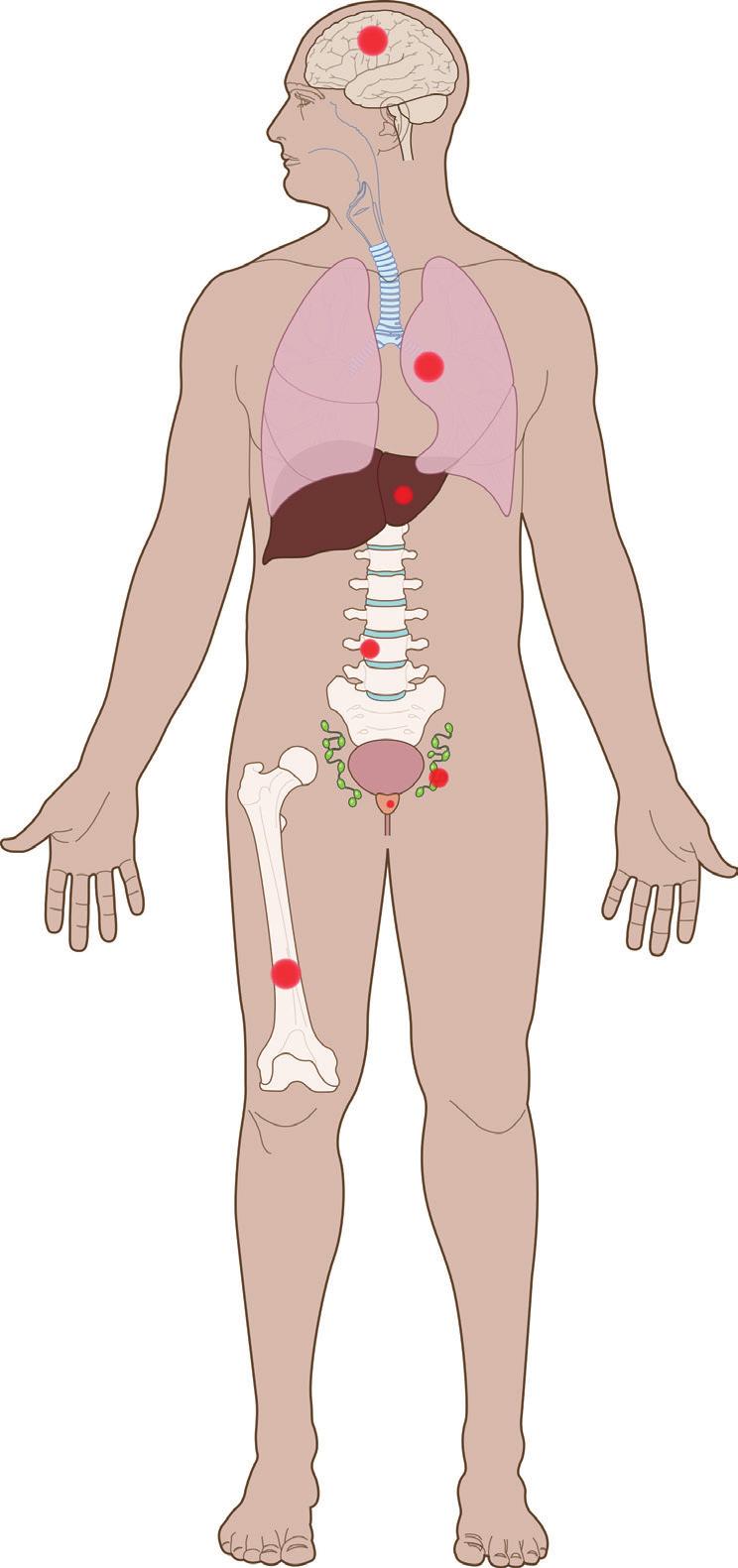 metástases cerebrais metástases pulmonares metástases hepáticas metástases espinhais gânglios linfáticos pélvicos tumor da próstata metástases ósseas Opções de tratamento 2017 patient.