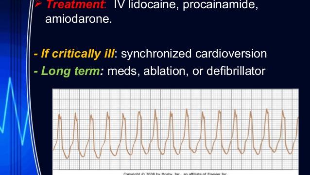 Taquicardia regular de QRS largo Disssociação