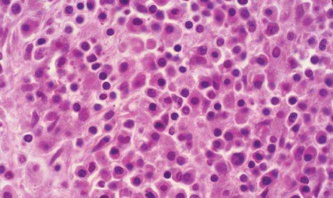 Padrão linfo-histiocítico No grande aumento, as células malignas encontram-se misturadas a uma população não