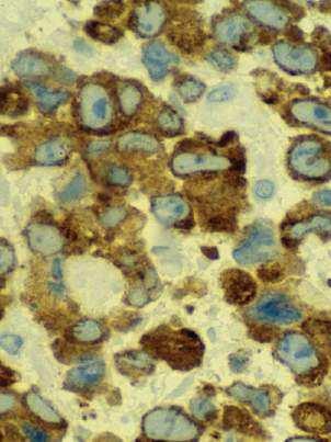 Padrão de marcação do ALK (Anaplastic lymphoma kinase)