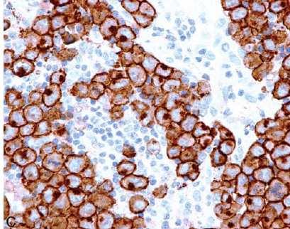 Linfoma de Grandes Células Anaplásicas, ALK- (categoria provisória) Morfologia: Idêntico ao LAGC ALK+ Grande células