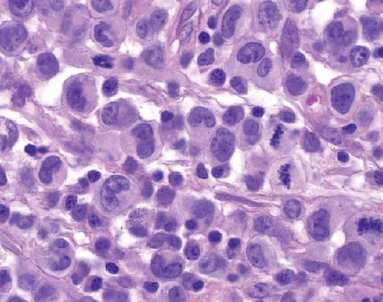 forte e difuso Antígenos de células B negativos (Pax5-) ALK- CD3 Clínica: Adulto (med 6 anos) Prognóstico