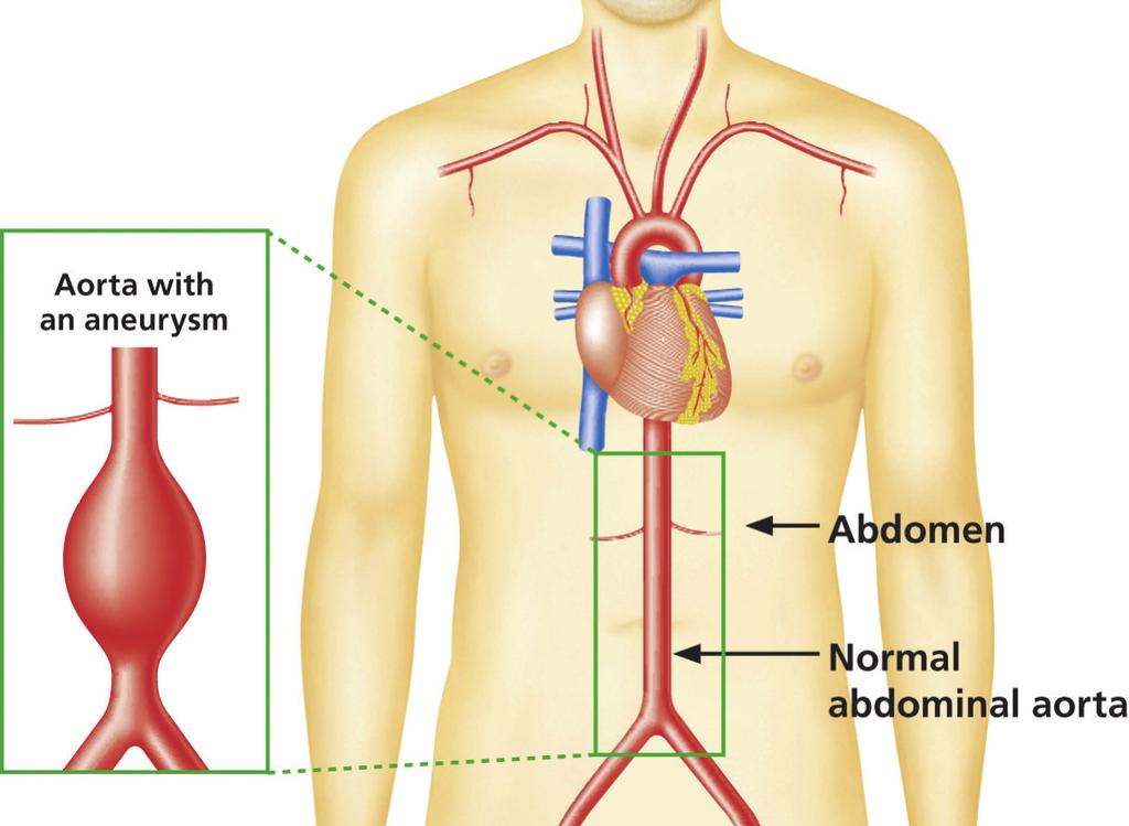 O resultado do seu rastreio Constatámos que uma secção da sua aorta é bastante maior do que o normal.