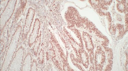 Figura 1 Adenocarcinoma colorretal: expressão e perda de expressão de enzimas de reparo do DNA. Mucosa normal Tumor cnúclsoe Mucosa normal Tumor cnúclsoe Figura 1a. Figura 1b.