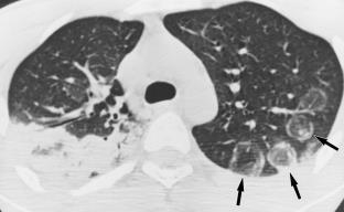 Fleischner Society: glossary of terms for thoracic