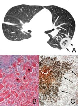 AS, Hochhegger B. The Reversed Halo Sign on High-resolution CT in Infectious and Non-infectious Pulmonary Diseases. AJR 2011;197(1):69-75.