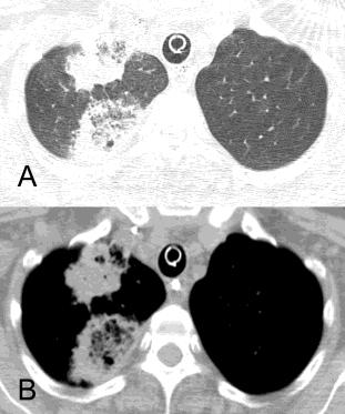 Reversed halo sign in active pulmonary tuberculosis: criteria for differential diagnosis from cryptogenic organizing pneumonia. AJR 2011; 197:1324-1327.