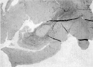 146 J Vasc Bras 2012, Vol. 11, Nº 2 Isquemia aguda: doença cística das artérias - Nasser M et al. Figura 5.