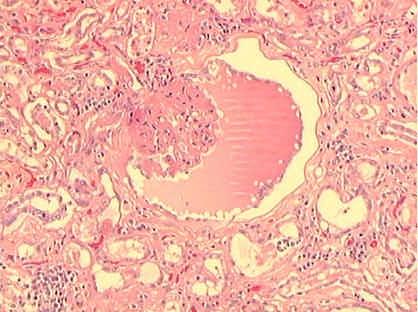 E A F Figura 2 Fotomicrografia do tecido renal de cão ilustrando edema glomerular (E), esclerose e