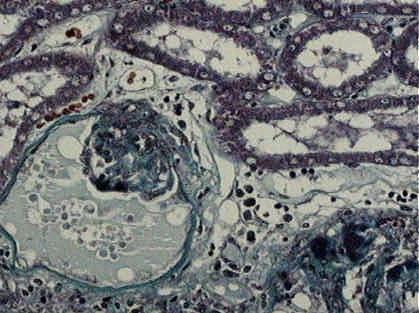 20 E Figura 9 Fotomicrografia do tecido renal de cão ilustrando espessamento de cápsula glomerular