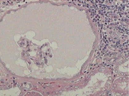 E I Figura 10 Fotomicrografia do tecido renal de cão ilustrando edema glomerular (E), infiltrado