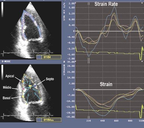 Painel inferior: traçado de paciente do grupo CFI-2, onde se observa retraso no início da deformação sistólica na região apical (setas da esquerda) e falha no final da deformação na região da parede