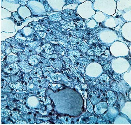 Tecido adiposo multilocular Células menores com arranjo epitelioide Não há neoformação de tecido