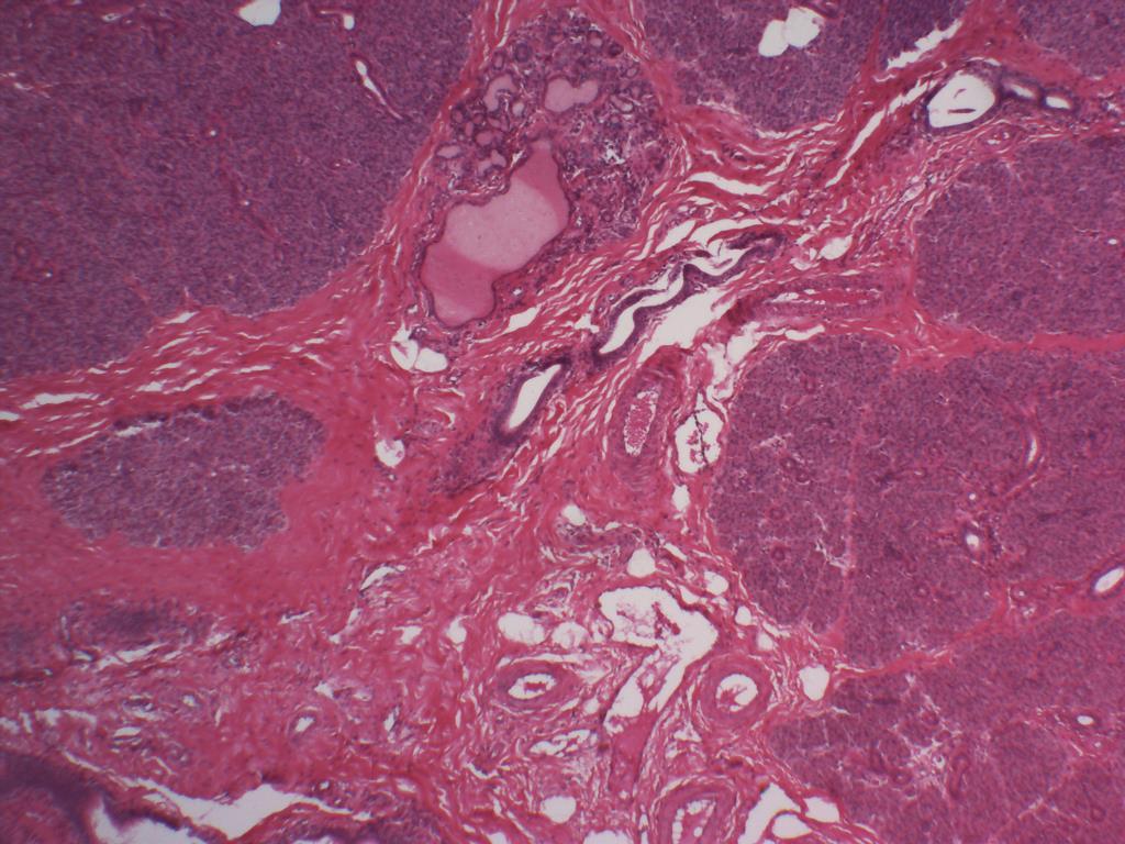 50 Cápsula Lóbulos glandulares acúmulo de adenômeros Septo interlobular Figura 8.1.