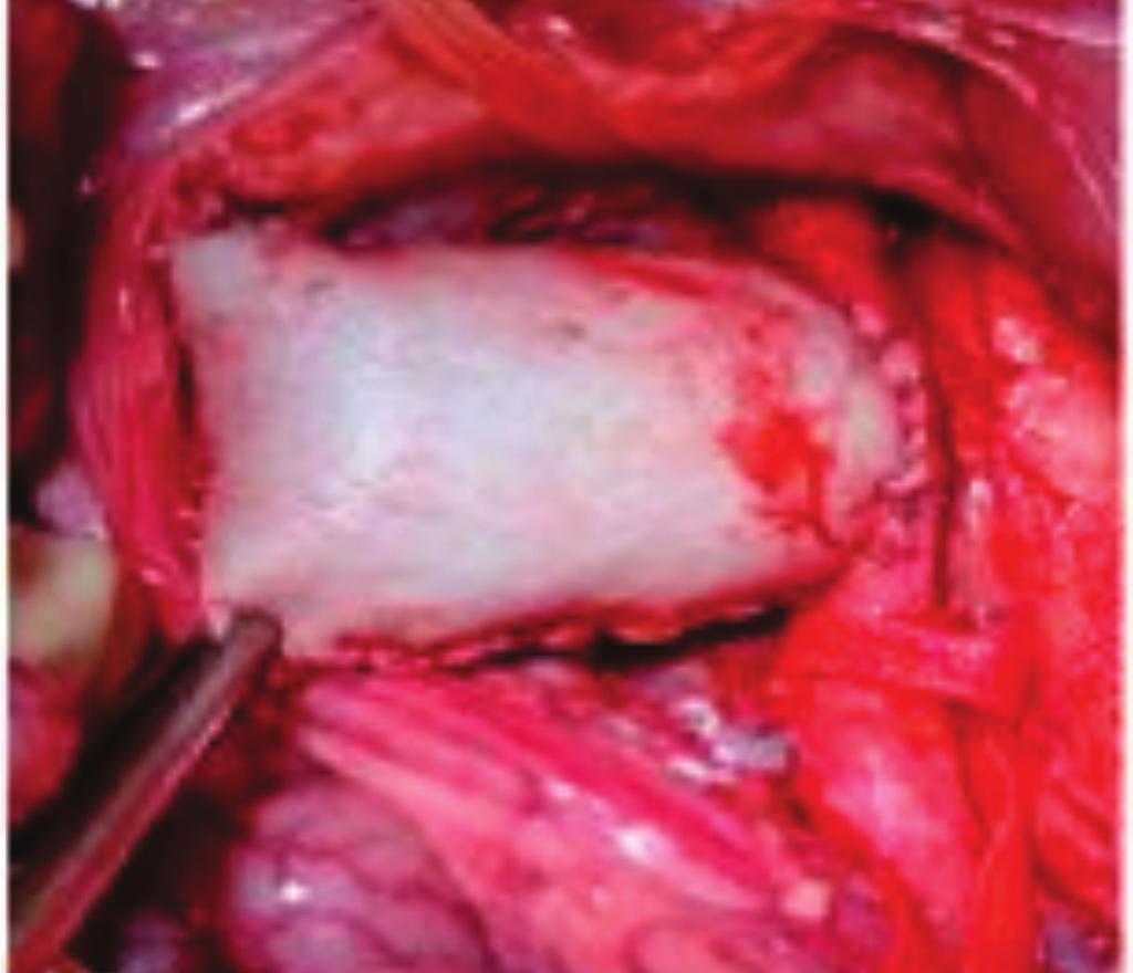 Oliveira 155 abdominal infrarrenal produzidos artificialmente segundo a técnica de Perini 17 modificada, conforme descrição: - Exposição da aorta abdominal por via transabdominal, com incisão mediana