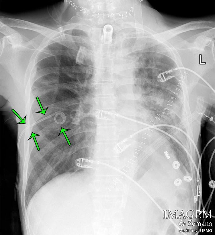 Imagem 2 Radiografia de tórax em AP após inserção de cateter pigtail à direita (setas).