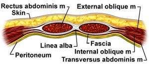Fusão incompleta das pregas laterais do músculo reto abdominal e de sua fáscia na região do umbigo. Pode ser desencadeada por da pressão abdominal obesidade, prenhez, trauma.