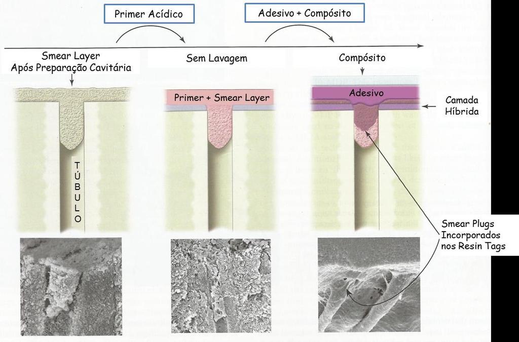 Estudo in vitro da resistência adesiva, por microtração, de um novo sistema adesivo de ionómero de vidro modificado por resina abordagem, verifica-se uma diminuição dos defeitos estruturais da